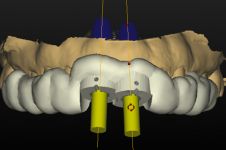 Comprehensive Digital Implant Workflow: Plan, Print, Place, and Restore