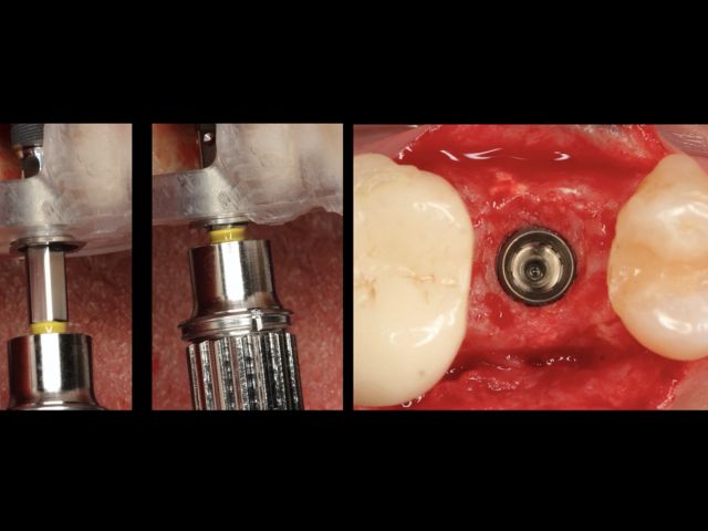 PrimeTaper Guided with Sinus LIft