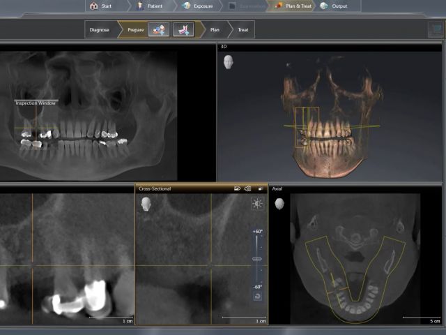 Treatment Planning For Implant 3 With Rapid Guide