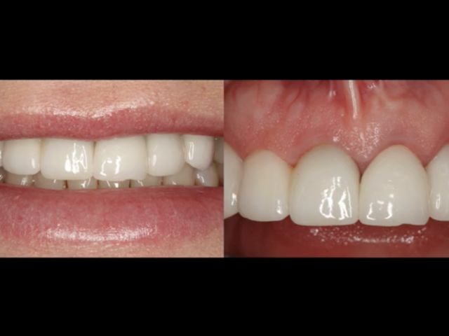 Esthetic Zone Immediate Implant Placement Complication