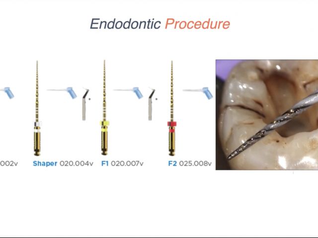 Endodontic Case 13 - Anterior Trauma - Procedure - Part 2