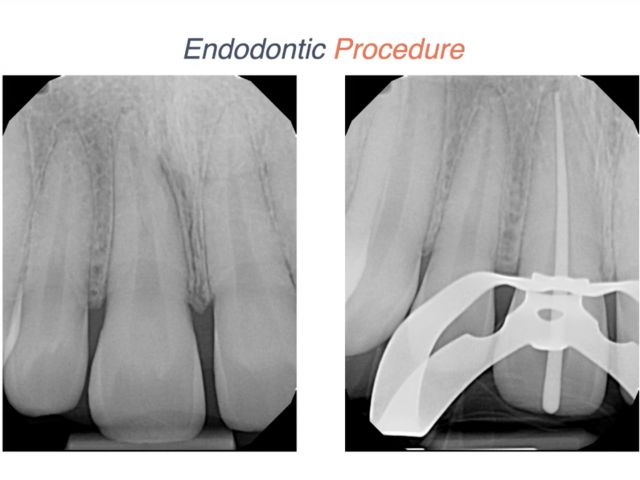 Endodontic Case 13 - Anterior Trauma - Obturation