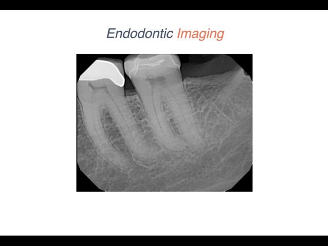 Endodontic Case 14 - New Crown Endodontics - Diagnosis