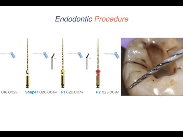 Endodontic Case 14 - New Crown Endodontics - Procedure