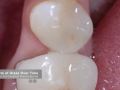 The Effects of Glaze Over Time on All Ceramic Restorations