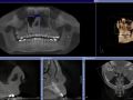 Nasal Septal Deviation With Ostiomeatal Obstruction
