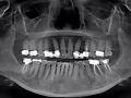 LOWER IMMEDIATE MOLAR WITH TRI MAX IMPLANT LARGE BODY