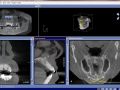Implant Planning with Cone Beam