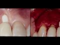 Managing soft tissue complications in esthetic implant dentistry – Part 5