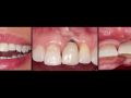Managing soft tissue complications in esthetic implant dentistry – Part 6