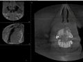 THE VALUE AND USE OF CBVT IMAGING IN THE DIAGONSIS AND TREATMENT OF A LIFE THREATENING TRAUMA IN A GENERAL DENTAL PRACTICE