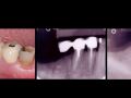 Minimally traumatic extractions in implant dentistry – Part 3