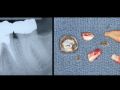 Minimally Traumatic Extractions in Implant Dentistry – Part 5