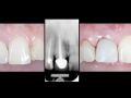 Minimally traumatic extractions in implant dentistry – Part 6