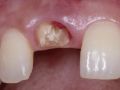 Replacement of hopeless teeth in the esthetic zone – Part 3