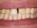 Replacement of hopeless teeth in the esthetic zone – Part 6