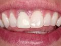 Replacement of hopeless teeth in the esthetic zone – Part 7