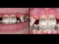 The Congenitally Missing Lateral Incisor - Part 2