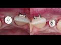 The Congenitally Missing Lateral Incisor - Part 3