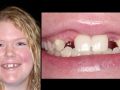 The Congenitally Missing Lateral Incisor - Part 4