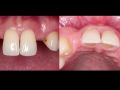 The Congenitally Missing Lateral Incisor - Part 5