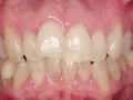 The Application of Transitional Implants in Reconstructive Dentistry - Part 1