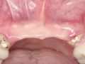 The Application of Transitional Implants in Reconstructive Dentistry - Part 4