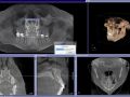 Incidental Findings in an Asymptomatic Patient - Silent Sinus Syndrome with Fibrous Dysplasia