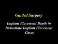 Guided Surgery Tips and Tricks – Part 2