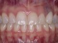 The Application of Periodontal Plastic Surgery in Esthetic Implant Dentistry - Part 3