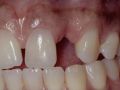 The Application of Periodontal Plastic Surgery in Esthetic Implant Dentistry - Part 5