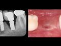 How to Remove Failing Osseointegrated Dental Implants - Part 1