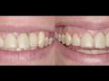 How to Remove Failing Osseointegrated Dental Implants - Part 2