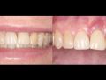 How to Remove Failing Osseointegrated Dental Implants - Part 4