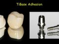 e.max CAD Abutments - Adhesion to the TiBase