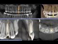 Continuum (Curriculum Series) - Surgical Video Presentation - Immediate Replacement of a Central Incisor