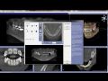 Continuum (Curriculum Series) - Surgical Video Presentation - Fully Integrated Digital Implant Dentistry