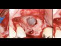 Continuum (Curriculum Series) - Surgical Video Presentation - Maxillary Sinus Augmentation via a Lateral Window Approach