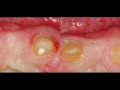 Continuum (Curriculum Series) - Surgical Video Presentation - Replacement of a Congenitally Missing Lateral Incisors