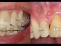 Continuum (Curriculum Series) - Surgical Video Presentation - Replacement of a Maxillary Central Incisor with Simultaneous Root Coverage Grafting with Perioderm