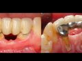 Continuum (Curriculum Series) - Surgical Video Presentation - Surgical Reconstruction of a Horizontal and Vertical Ridge Defect in the Anterior Mandible