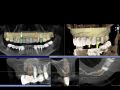 Continuum (Curriculum Series) - Surgical Video Presentation - Surgical Reconstruction of a Severe Horizontal Alveolar Ridge Defect in the Anterior Maxilla