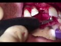 Continuum (Curriculum Series) - Surgical Video Presentation - Surgical Reconstruction of a Horizontal and Vertical Alveolar Ridge Defect in the Anterior Maxilla