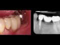 Continuum (Curriculum Series) - Surgical Video Presentation – Socket Grafting After Extraction of a Maxillary First Premolar