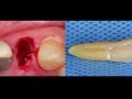 Continuum (Curriculum Series) - Surgical Video Presentation – Socket Grafting After Extraction of a Molar