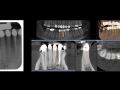 Continuum (Curriculum Series) - Surgical Video Presentation – Replacement of a Mandibular Incisor with the Socket Shield Technique