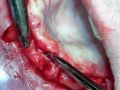 Continuum (Curriculum Series) - Surgical Video Presentation – Implant Placement in the Fully Edentulous Maxilla with a Bone Supported Surgical Guide
