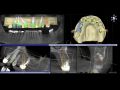 Continuum (Curriculum Series ) - Surgical Video Presentation – All-On-6 Immediate Full Arch Implant Reconstruction in the Maxilla
