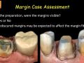 PBN Subgingival Margins Study - 5. Preparation Case Assessment
