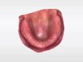 11. CEREC Primescan Edentulous Ridge and Denture Applications